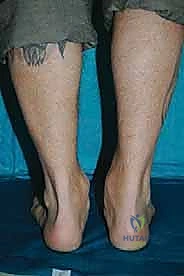 صورة طبية: إعادة بناء آفة الكاحل الغضروفية العظمية الكبيرة بالطعم الخيفي الهيكلي: دليل شامل للمرضى مع الأستاذ الدكتور محمد هطيف