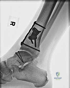 صورة طبية: إعادة بناء آفة الكاحل الغضروفية العظمية الكبيرة بالطعم الخيفي الهيكلي: دليل شامل للمرضى مع الأستاذ الدكتور محمد هطيف