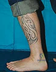 صورة طبية: إعادة بناء آفة الكاحل الغضروفية العظمية الكبيرة بالطعم الخيفي الهيكلي: دليل شامل للمرضى مع الأستاذ الدكتور محمد هطيف