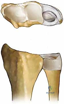 صورة طبية: جراحة تقصير الزند: حل نهائي لآلام الرسغ المزمنة مع الأستاذ الدكتور محمد هطيف في صنعاء