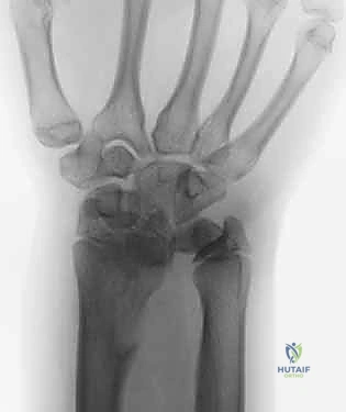 التثبيت النهائي بالمسامير