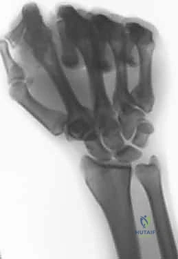 صورة توضيحية لـ جراحة تقصير الزند: حل نهائي لآلام الرسغ المزمنة مع الأستاذ الدكتور محمد هطيف في صنعاء