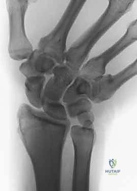 صورة طبية: جراحة تقصير الزند: حل نهائي لآلام الرسغ المزمنة مع الأستاذ الدكتور محمد هطيف في صنعاء