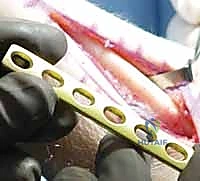 صورة طبية: جراحة تقصير الزند: حل نهائي لآلام الرسغ المزمنة مع الأستاذ الدكتور محمد هطيف في صنعاء