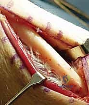 صورة توضيحية لـ جراحة تقصير الزند: حل نهائي لآلام الرسغ المزمنة مع الأستاذ الدكتور محمد هطيف في صنعاء