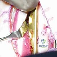 صورة طبية: جراحة تقصير الزند: حل نهائي لآلام الرسغ المزمنة مع الأستاذ الدكتور محمد هطيف في صنعاء