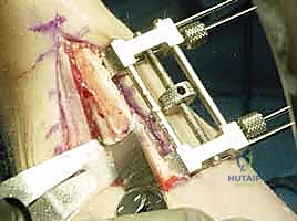 صورة طبية: جراحة تقصير الزند: حل نهائي لآلام الرسغ المزمنة مع الأستاذ الدكتور محمد هطيف في صنعاء