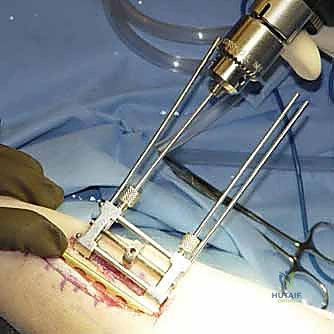 صورة طبية: جراحة تقصير الزند: حل نهائي لآلام الرسغ المزمنة مع الأستاذ الدكتور محمد هطيف في صنعاء