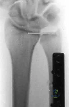 صورة توضيحية لـ جراحة تقصير الزند: حل نهائي لآلام الرسغ المزمنة مع الأستاذ الدكتور محمد هطيف في صنعاء