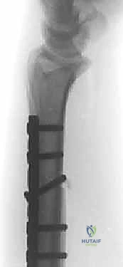 صورة توضيحية لـ جراحة تقصير الزند: حل نهائي لآلام الرسغ المزمنة مع الأستاذ الدكتور محمد هطيف في صنعاء