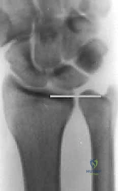 صورة طبية: جراحة تقصير الزند: حل نهائي لآلام الرسغ المزمنة مع الأستاذ الدكتور محمد هطيف في صنعاء