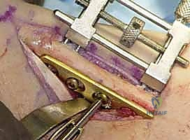 صورة شعاعية أثناء الجراحة للتأكد من المحاذاة