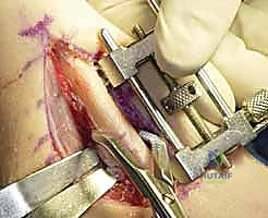 صورة توضيحية لـ جراحة تقصير الزند: حل نهائي لآلام الرسغ المزمنة مع الأستاذ الدكتور محمد هطيف في صنعاء