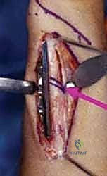 صورة طبية: جراحة تقصير الزند: حل نهائي لآلام الرسغ المزمنة مع الأستاذ الدكتور محمد هطيف في صنعاء