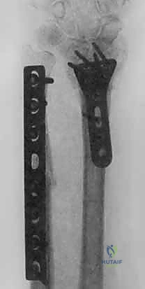 Illustration of ulnar shortening osteotomy - Dr. Mohammed Hutaif