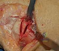 Intraoperative Surgical Step