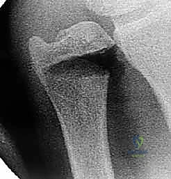 صورة طبية: جراحة تقصير الزند: حل نهائي لآلام الرسغ المزمنة مع الأستاذ الدكتور محمد هطيف في صنعاء