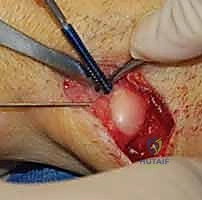 صورة طبية: جراحة تقصير الزند: حل نهائي لآلام الرسغ المزمنة مع الأستاذ الدكتور محمد هطيف في صنعاء