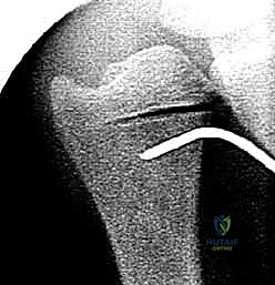 صورة طبية: جراحة تقصير الزند: حل نهائي لآلام الرسغ المزمنة مع الأستاذ الدكتور محمد هطيف في صنعاء