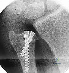 تقريب حواف العظم