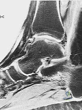 Autologous Chondrocyte Implantation for Talar Osteochondral Lesions: An Intraoperative Masterclass