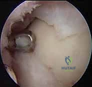 صورة توضيحية لتشخيص آفات الغضروف العظمي