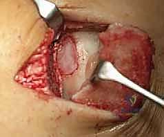 صورة توضيحية لـ زراعة الغضاريف الذاتية للكاحل: حل متطور لآفات الغضروف العظمي واستعادة الحركة