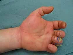 تشريح أحياز اليد المعقدة