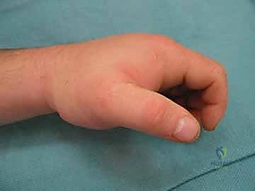 أسباب متلازمة الحيز في الطرف العلوي