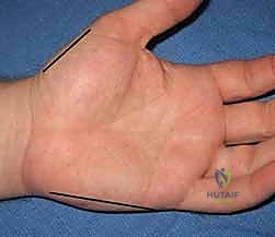 الشق الجراحي الخلفي للساعد