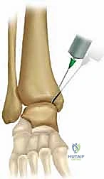 صورة توضيحية لـ استئصال الكعب الإنسي على شكل شيفرون: دليل شامل لعلاج إصابات قبة الكاحل المعقدة مع الأستاذ الدكتور محمد هطيف