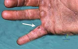 التنضير الجراحي الدقيق لليد