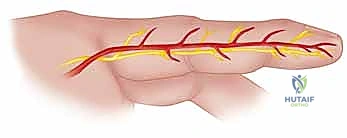 غسيل الأوتار والأنسجة الرخوة