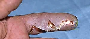 التنظيف العميق للمستويات اللفافية