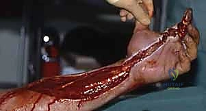 صورة لشق جراحي دقيق في اليد