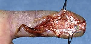 التعامل مع الأوعية الدموية الدقيقة