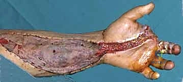 النتيجة النهائية ونجاح الجراحة