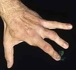 تحرير الأوتار والأعصاب المتضررة