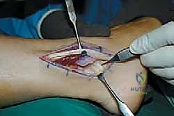 الشق الجراحي المبدئي