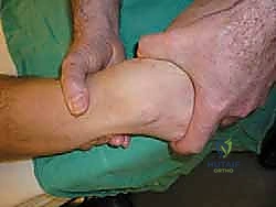 توضيح لعدم استقرار الكاحل المزمن