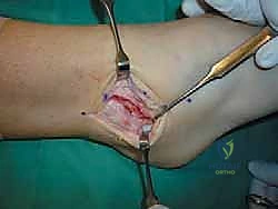 اختبار الثبات الجانبي للكاحل