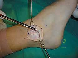 تقييم الأربطة بالأشعة