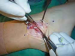 مقارنة بين الأربطة السليمة والممزقة