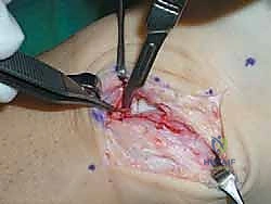 تقييم الأربطة الممزقة 1