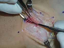 تجهيز المريض في غرفة العمليات