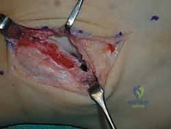 صورة توضيحية لـ إتقان إصلاح أربطة الكاحل الجانبية: دليل شامل لعملية بروسترم المعدلة مع الأستاذ الدكتور محمد هطيف