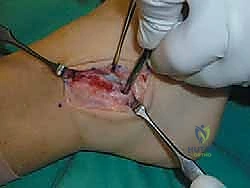 تحضير سطح العظم