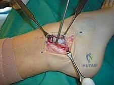 التحضير لإعادة البناء