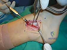 إبعاد الأنسجة بأمان