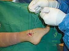 تقييم الأربطة الممزقة 2